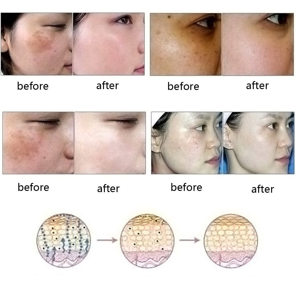 Dredge Meridian Skin Care Natural Pure Removal Acne Stretch Marks Scar Remova - الصورة 8